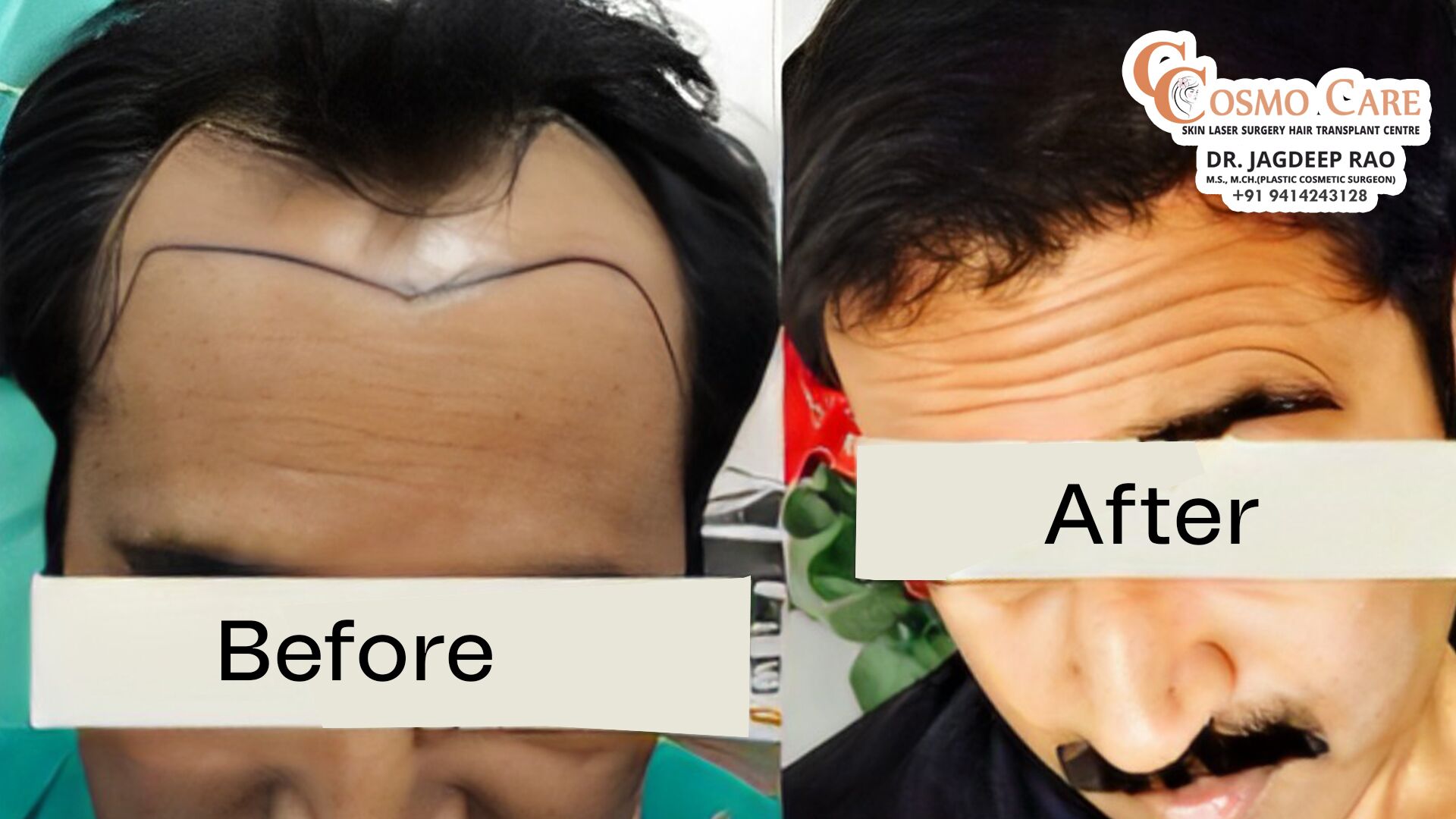 Best hair transplant in Jaipur | thumbnail copy